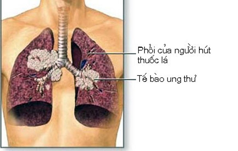 Paul Tillotson, 62 tuổi dù không có thói quen hút thuốc nhưng trong một lần chụp X – quang, anh được phát hiện có những dấu hiệu đáng ngờ ở phổi. Ngay sau đó, các bác sĩ đã tiến hành sinh thiết và kết luận Paul đã mắc ung thư phổi ở giai đoạn ba – giai đoạn có thể nguy hiểm đến tính mạng.